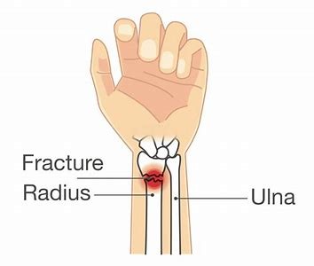 Image showcasing Fractured Radius