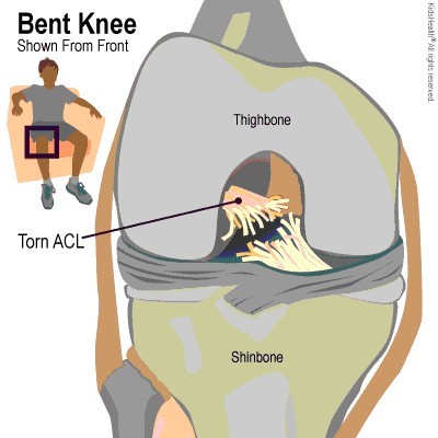 a bent knee with a torn ACL