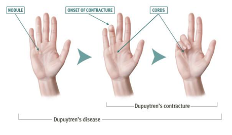 a hand with different stages of dupytrens disease