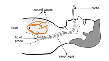 of the upper body showing where the heart is and how the ultrasound probe goes down a persons throat to sit behind the heart