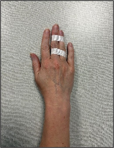 Buddy Strapping - strapping an injured finger to another to keep it in place.