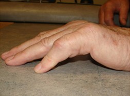 a hand with advanced dupuytrens showing a gap between the table and the hand when the hand is put flat