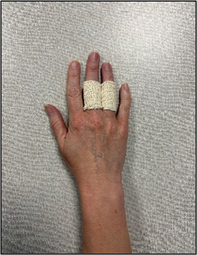 Bedford Splint - A support brace that holds an injured finger in place with the adjacent finger.
