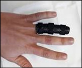 Thermoplastic Splint - A plastic splint that holds and support the injured finger in place.