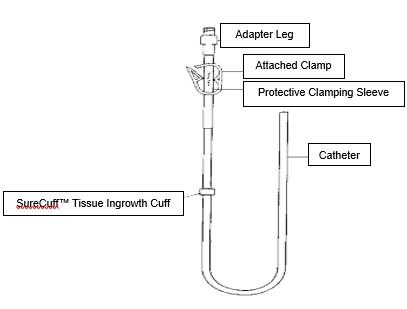 A picture of a Hickman Line, describing  its different parts.