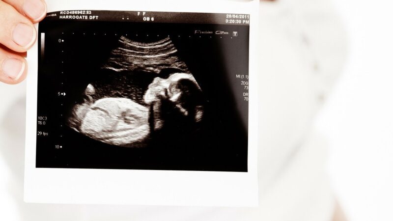 Pregnant woman holds a scan.